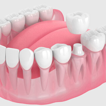 When Are Dental Crowns Necessary? 5 Situations That Require A Dental Crown
